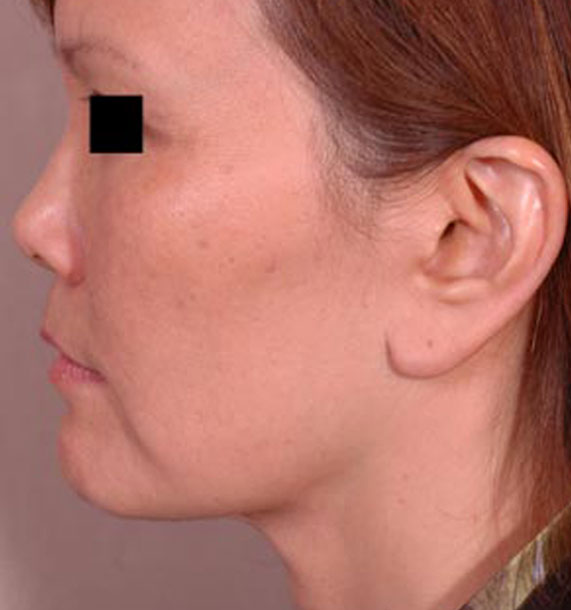 Mini Face Lift Procedure: After Treatment Photo - female, left side view, patient 13