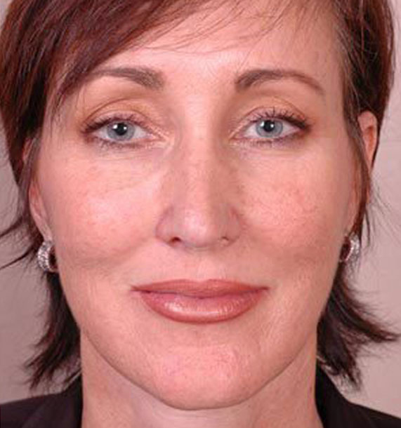 Mini Face Lift Procedure: After Treatment Photo - female, front view, patient 14