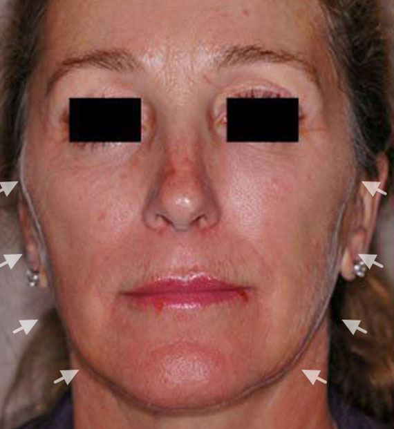 Facelift in my 60s - Before Treatment Photo - female, front view, patient 2