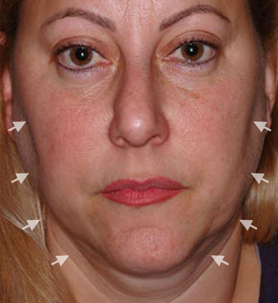 Facelift in my 60s - Before Treatment Photo - female, frontal view, patient 4