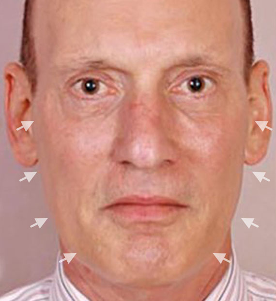 Facelift in my 60s - Before Treatment Photo - male, front view, patient 5