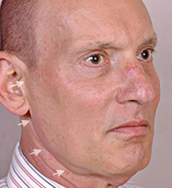 Facelift in my 60s - Before Treatment Photo - male, oblique view, patient 5