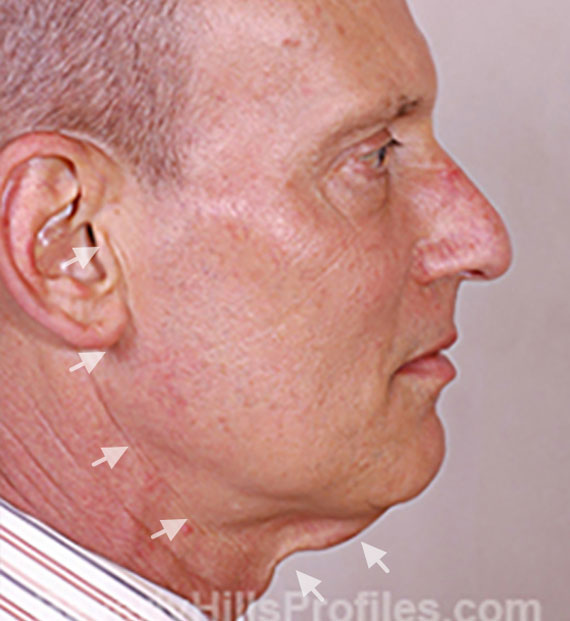 Facelift in my 60s - Before Treatment Photo - male, right side view, patient 5