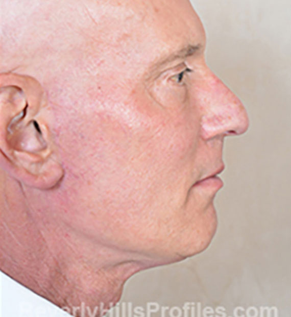 Facelift in my 60s - After Treatment Photo - male, right side view, patient 5