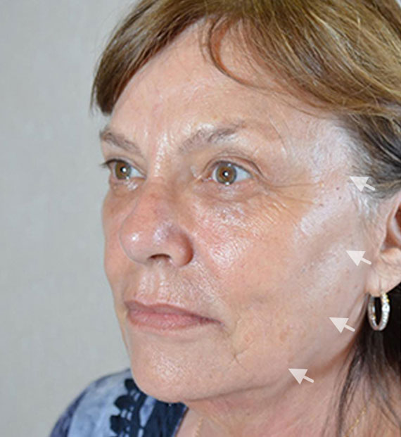 Facelift in my 60s - Before Treatment Photo - female, oblique view, patient 6