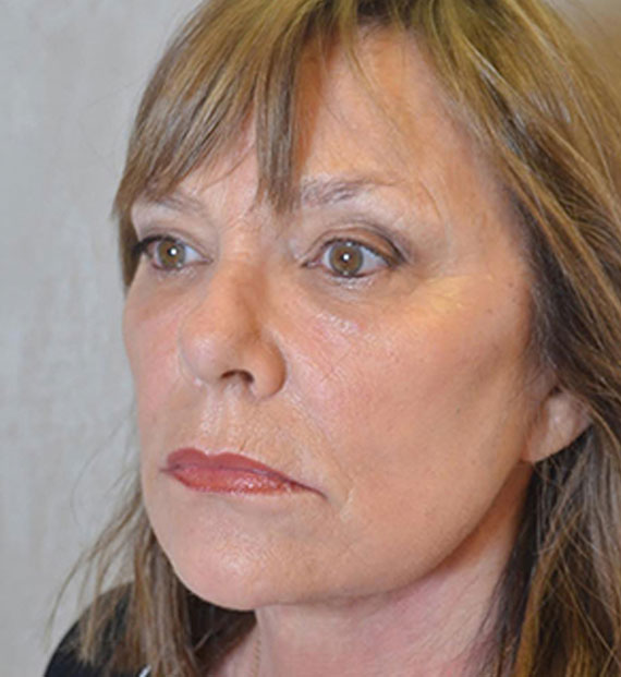 Facelift in my 60s - After Treatment Photo - female, oblique view, patient 6