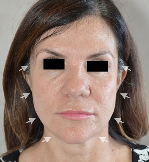 Facelift in my 60s - Before Treatment Photo - female, front view, patient 7