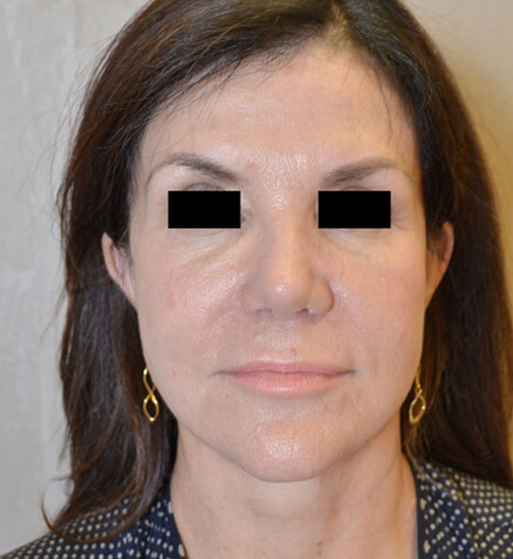 Facelift in my 60s - After Treatment Photo - female, front view, patient 7