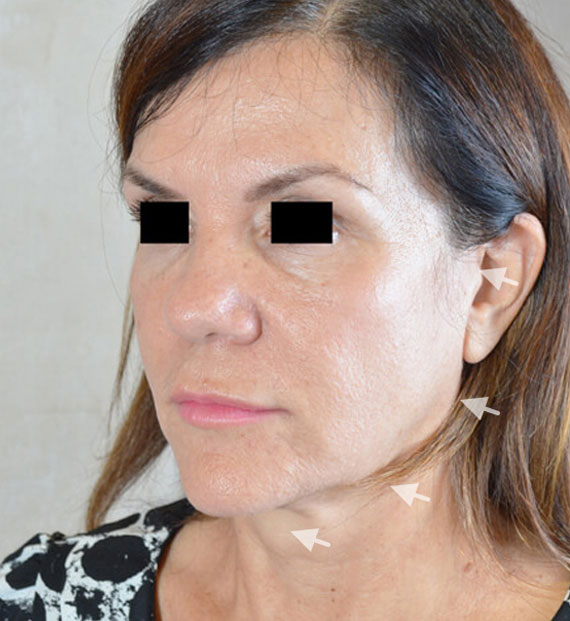 Facelift in my 60s - Before Treatment Photo - female, oblique view, patient 7