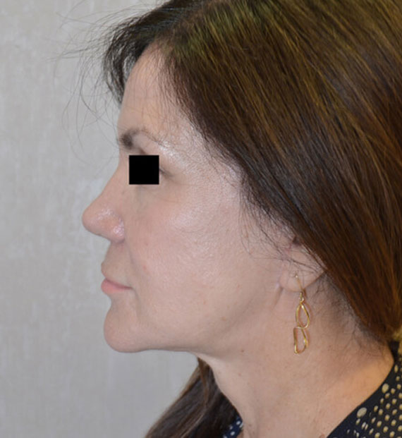 Facelift in my 60s - After Treatment Photo - female, left side view, patient 7