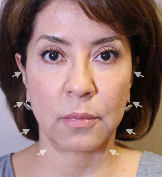 Facelift in my 60s - Before Treatment Photo - female, front view, patient 8
