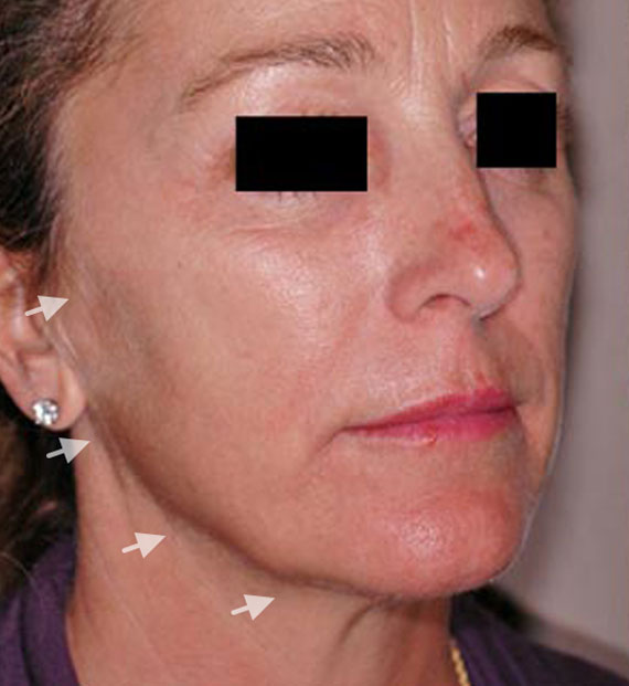 Facelift in my 60s - Before Treatment Photo - female, oblique view, patient 2