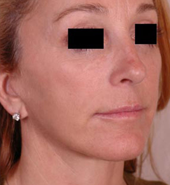 Facelift in my 60s - After Treatment Photo - female, oblique view, patient 2