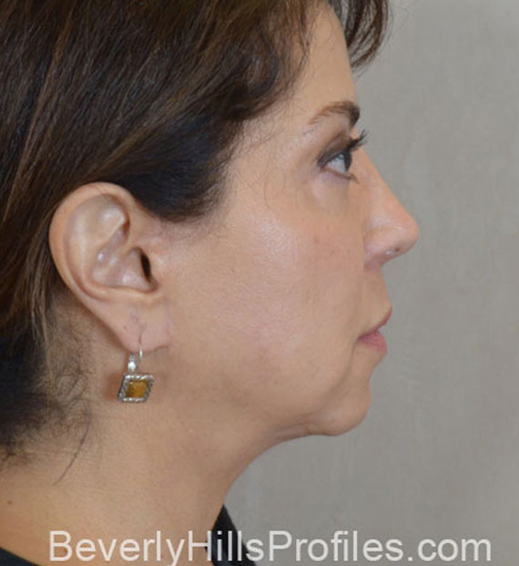 Facelift in my 60s - After Treatment Photo - female, right side view, patient 8