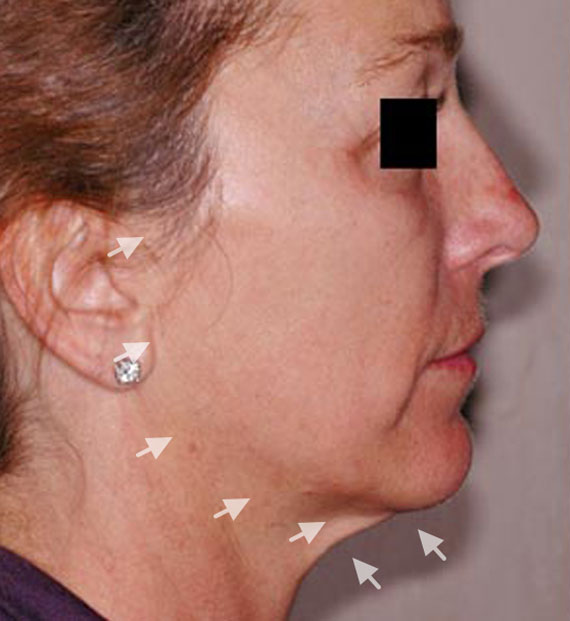 Facelift in my 60s - Before Treatment Photo - female, right side view, patient 2