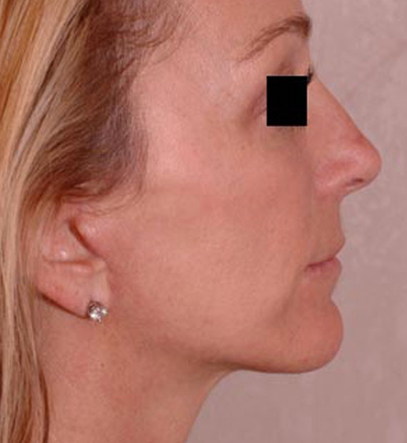 Facelift in my 60s - After Treatment Photo - female, right side view, patient 2