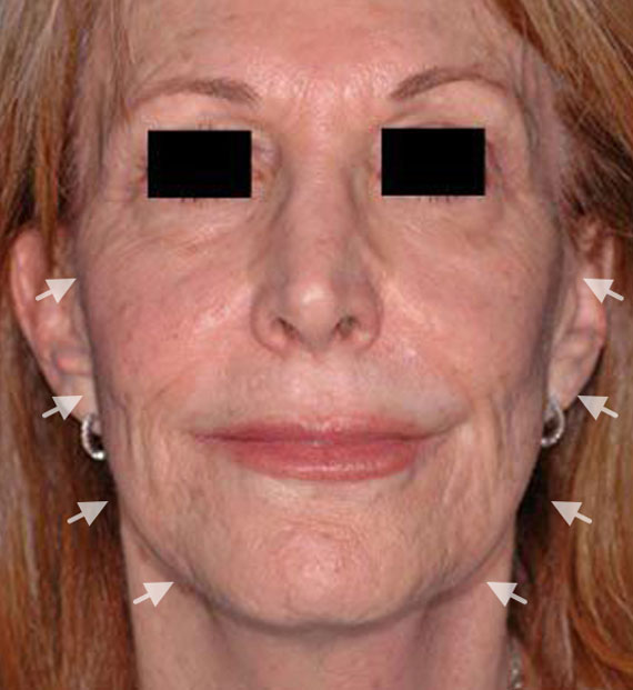 Facelift in my 60s - Before Treatment Photo - female, front view, patient 3