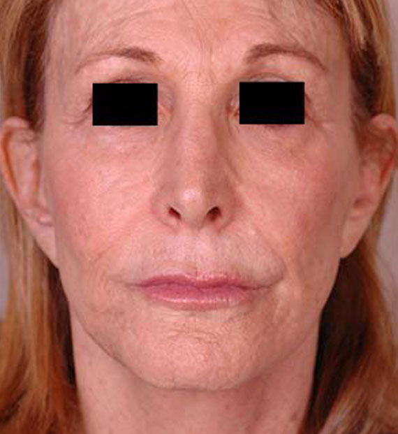 Facelift in my 60s - After Treatment Photo - female, front view, patient 3