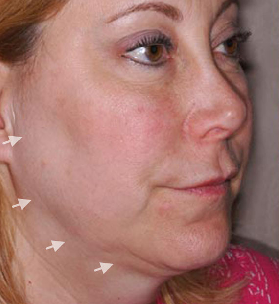 Facelift in my 60s - Before Treatment Photo - female, oblique view, patient 4