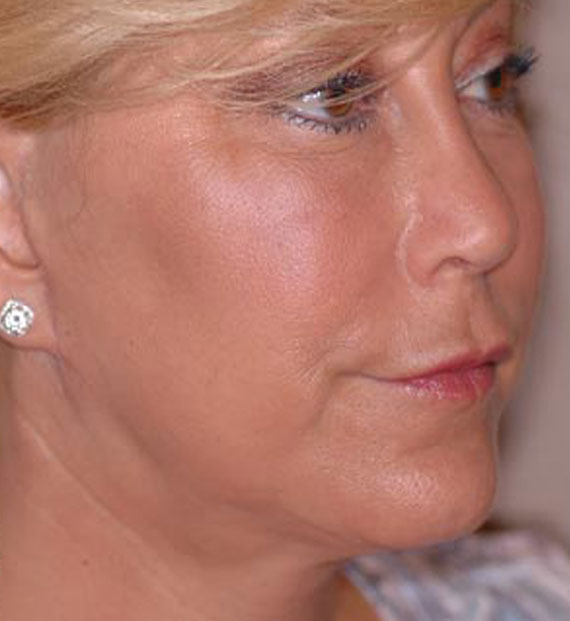 Facelift in my 60s - After Treatment Photo - female, oblique view, patient 4