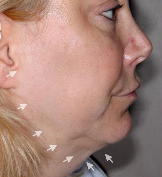 Facelift in my 60s - Before Treatment Photo - female, right side view, patient 4