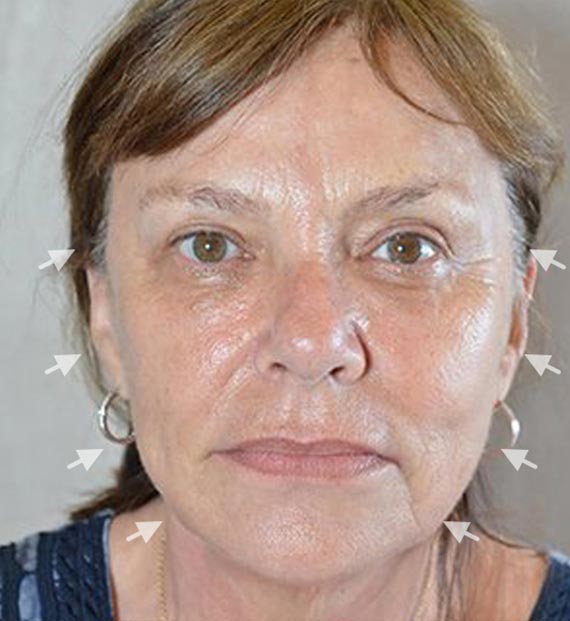 Facelift in my 60s - Before Treatment Photo - female, front view, patient 1