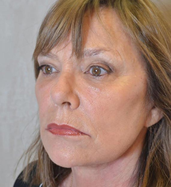 FaceLift - After Treatment Photo - female, left side oblique view, patient 1