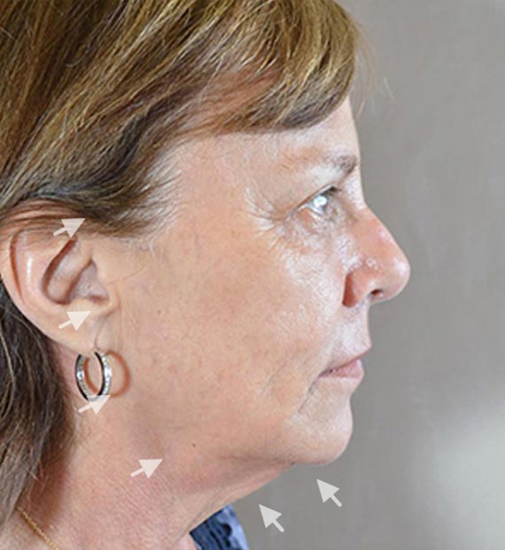 Facelift in my 60s - Before Treatment Photo - female, right side view, patient 1