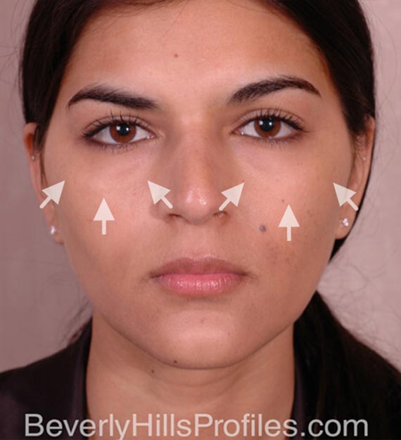 Fat Transfer. Before Treatment photo, female - front view, patient 2