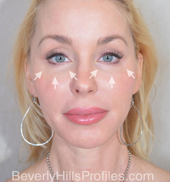 FaceLift - Before Treatment Photo - female, front view, patient 4