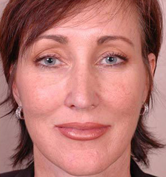 ANTI-AGING TREATMENTS IN MY 40S OR 50S - After Treatment Photo - female, front view, patient 1