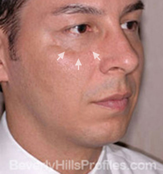 ANTI-AGING TREATMENTS IN MY 40S OR 50S - Before Treatment Photo - male, oblique view, patient 2