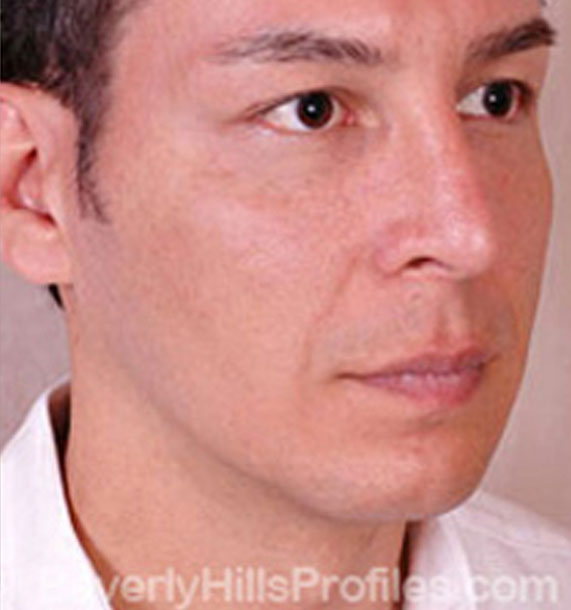 ANTI-AGING TREATMENTS IN MY 40S OR 50S - After Treatment Photo - male, oblique view, patient 2
