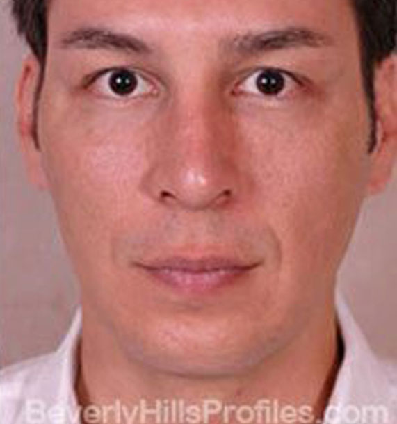 ANTI-AGING TREATMENTS IN MY 40S OR 50S - After Treatment Photo - male, front view, patient 2