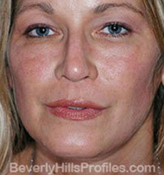 ANTI-AGING TREATMENTS IN MY 40S OR 50S - After Treatment Photo - female, front view, patient 3