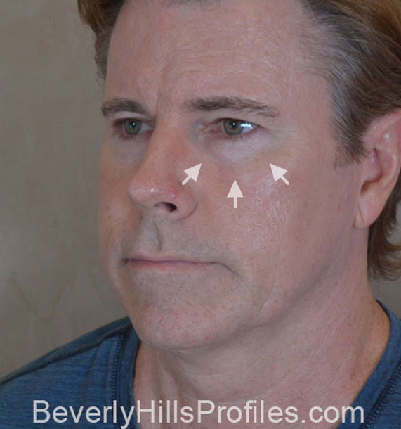 ANTI-AGING TREATMENTS IN MY 40S OR 50S - Before Treatment Photo - male, oblique view, patient 4
