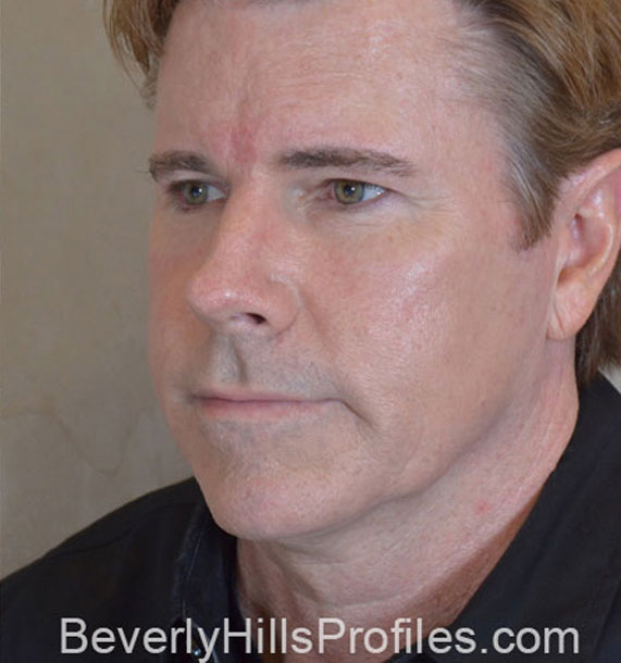 ANTI-AGING TREATMENTS IN MY 40S OR 50S - After Treatment Photo - male, oblique view, patient 4