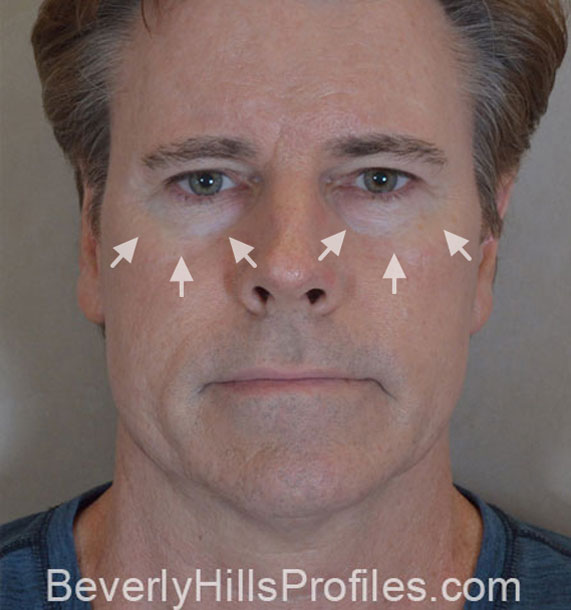 ANTI-AGING TREATMENTS IN MY 40S OR 50S - Before Treatment Photo - male, front view, patient 4