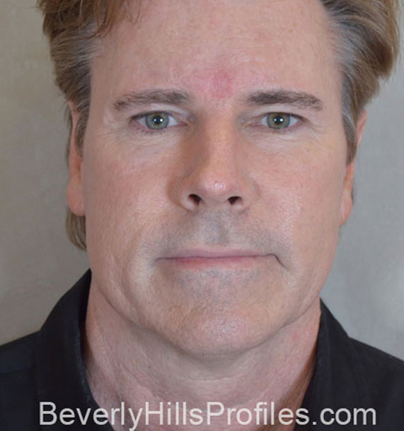 ANTI-AGING TREATMENTS IN MY 40S OR 50S - After Treatment Photo - male, front view, patient 4