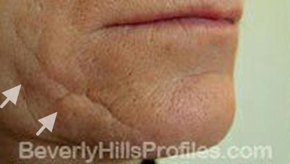 Injectable fillers: Before treatment photo, oblique view, patient 1