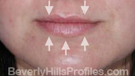 Injectable fillers: Before treatment photo, front view, female patient 2