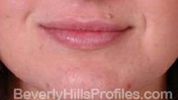Injectable fillers: After treatment photo, front view, female patient 2