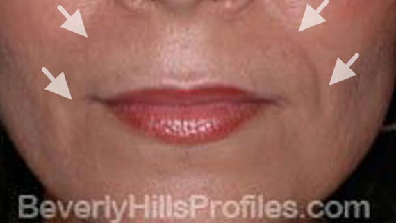 Injectable fillers: Before treatment photo, front view, female patient 3