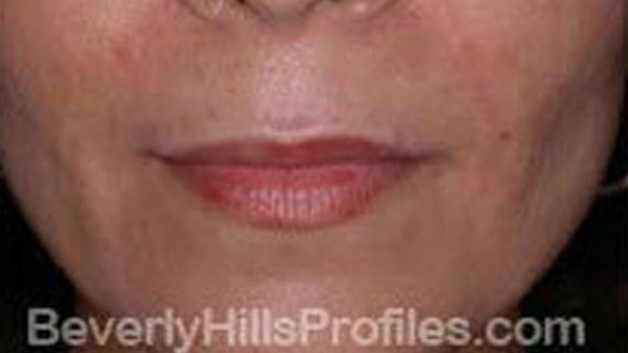 Injectable fillers: After treatment photo, front view, female patient 3