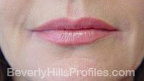 Injectable fillers: After treatment photo, front view, female patient 4