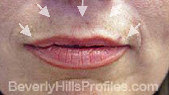 Injectable fillers: Before treatment photo, front view, female patient 5