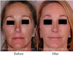 Woman’s face - Before Treatment Photo: front view, patient 1