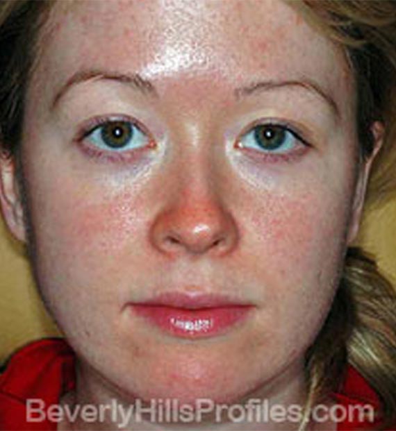 Intense Pulsed Light: Before treatment photo, front view, female patient 1