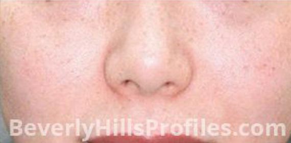 Intense Pulsed Light: After treatment photo, front view, female patient 2