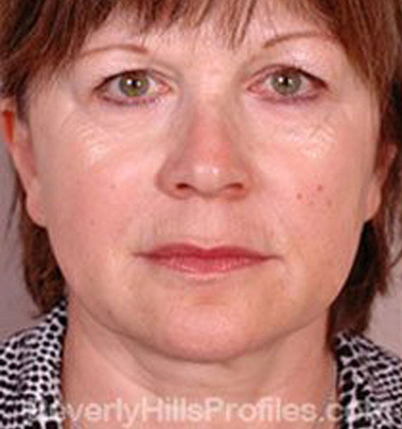 Intense Pulsed Light (IPL): Before Treatment Photo - female, front view, patient 1